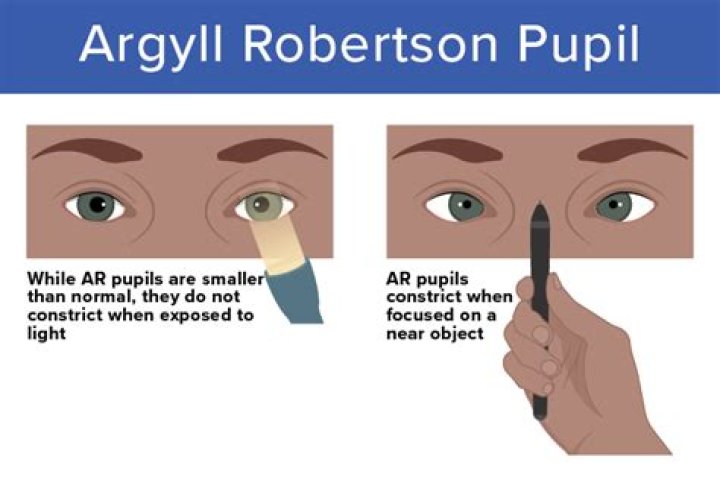What causes argyll robertson pupil?