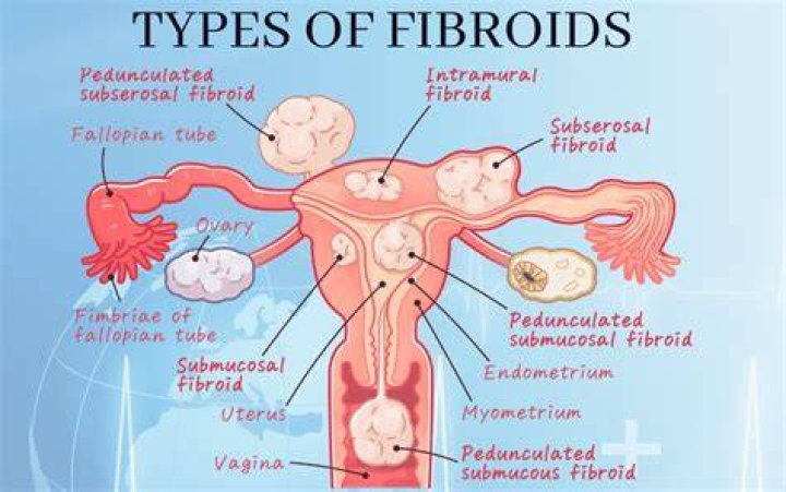 When fibroids degenerate do they bleed?